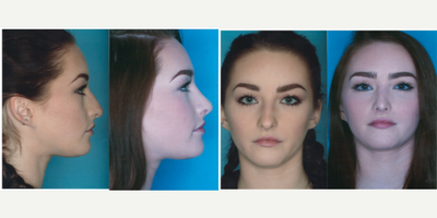 Rhinoplasty before and after photo