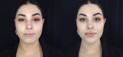Chin Filler before and after photo