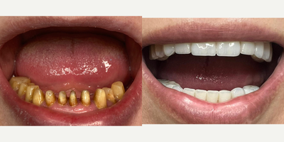 Dental Implants before and after photo