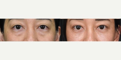 Eyelid Surgery before and after photo