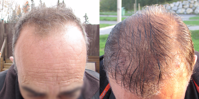 Hair Transplant before and after photo
