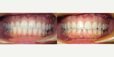 Invisalign before and after photo