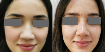 Nonsurgical Nose Job before and after photo