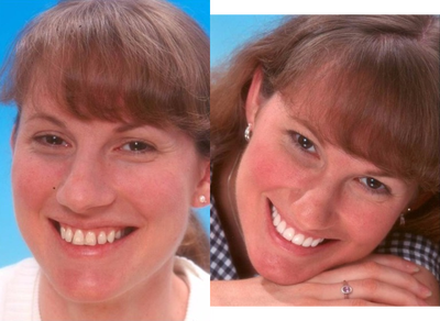 Porcelain Veneers before and after photo