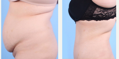 Tummy Tuck before and after photo