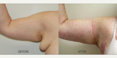 Arm Lift before and after photo