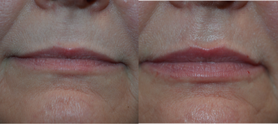 Lip Fillers before and after photo