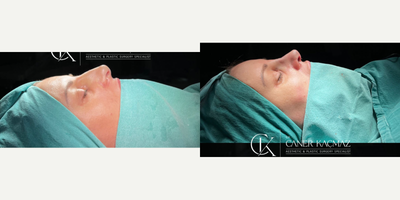 Rhinoplasty before and after photo