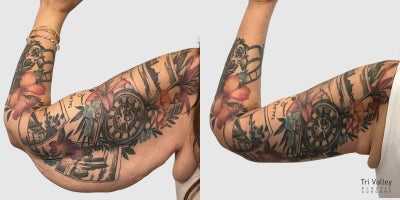 Arm Lift before and after photo