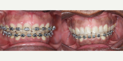 Braces before and after photo