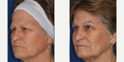 Brow Lift before and after photo