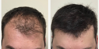 FUE Hair Transplant before and after photo