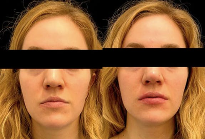 Nonsurgical Nose Job before and after photo