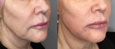 Thread Lift before and after photo