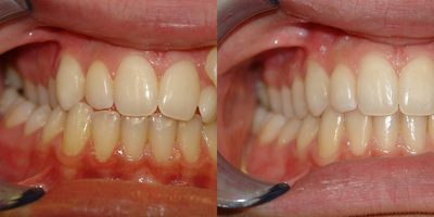Invisalign before and after photo