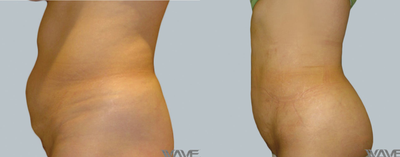 Liposuction before and after photo