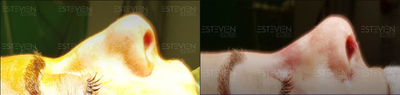 Rhinoplasty before and after photo