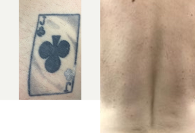 Tattoo Removal before and after photo