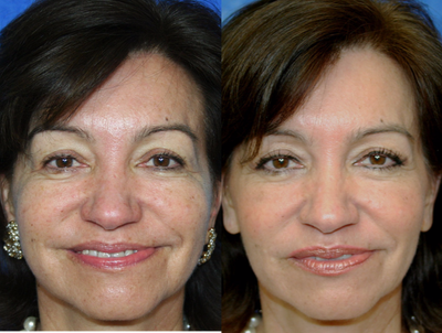 Nonsurgical Facelift before and after photo