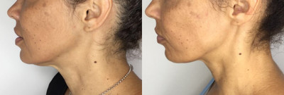 Skin Tightening before and after photo
