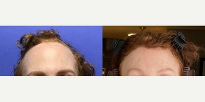 Transgender Facial Feminization Surgery before and after photo
