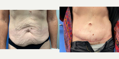 Tummy Tuck before and after photo