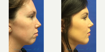 Chin Implant before and after photo