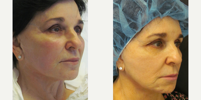 Dermal Fillers before and after photo