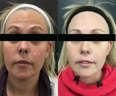 Dysport before and after photo