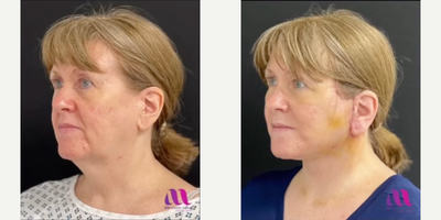 Mini Facelift before and after photo