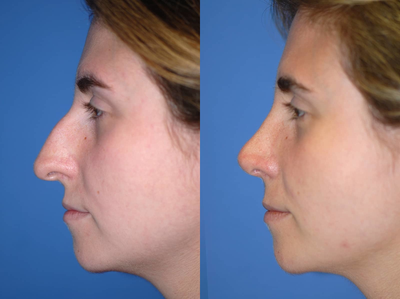 Asian Rhinoplasty before and after photo