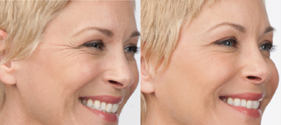 Botox before and after photo