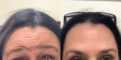 Botox before and after photo