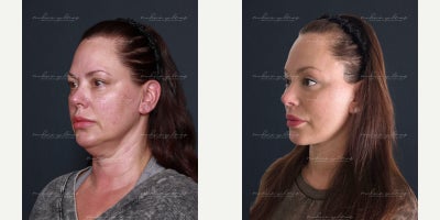 Brow Lift before and after photo