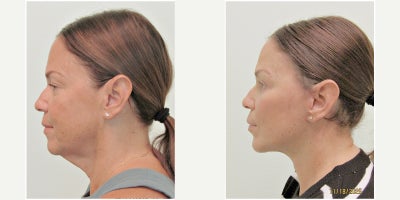 Neck Lift before and after photo