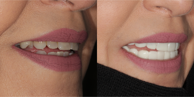 Snap-On Smile before and after photo