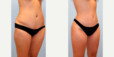 Butt Lift before and after photo