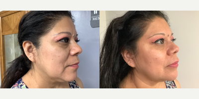 Dermal Fillers before and after photo