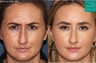 Dysport before and after photo