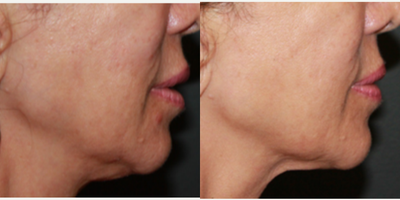 FaceTite before and after photo