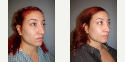 Rhinoplasty before and after photo