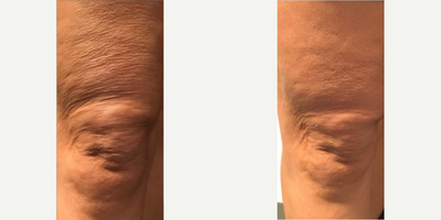 Skin Tightening before and after photo