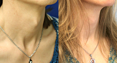 Adam's Apple Reduction before and after photo