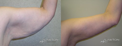 Arm Lift before and after photo