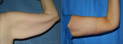 Arm Lift before and after photo