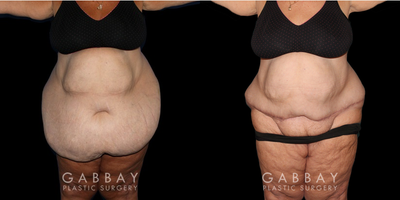 Body Lift before and after photo