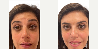 Botox before and after photo