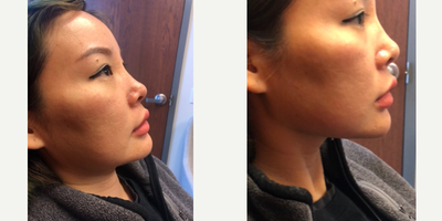 Dermal Fillers before and after photo
