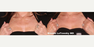 IPL before and after photo