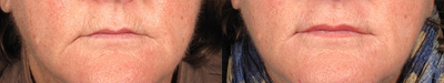 Juvederm before and after photo